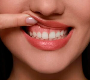 gengivoplastia LORENA BARRETTO ODONTOLOGIA periodontista em petropolis